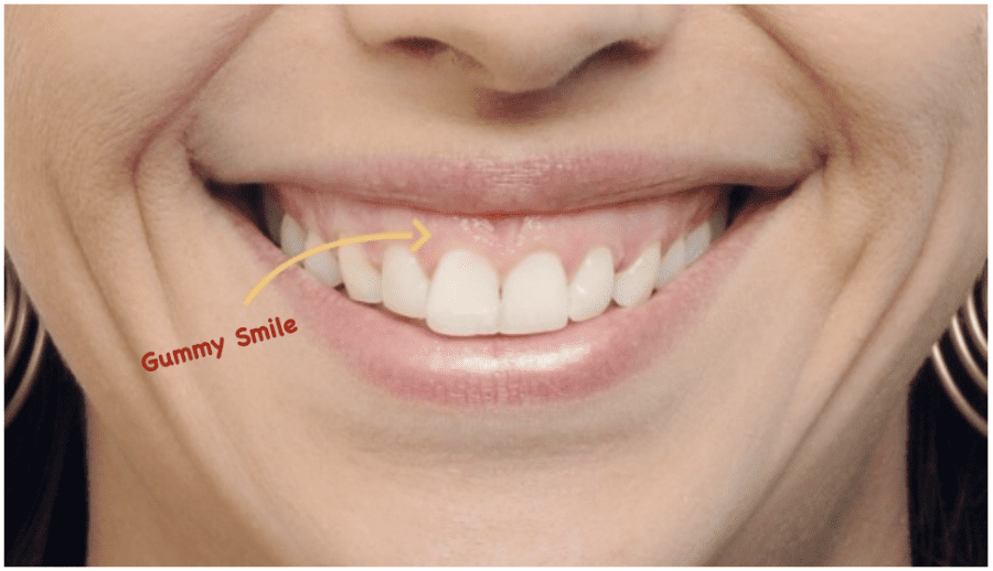 gummy smile
