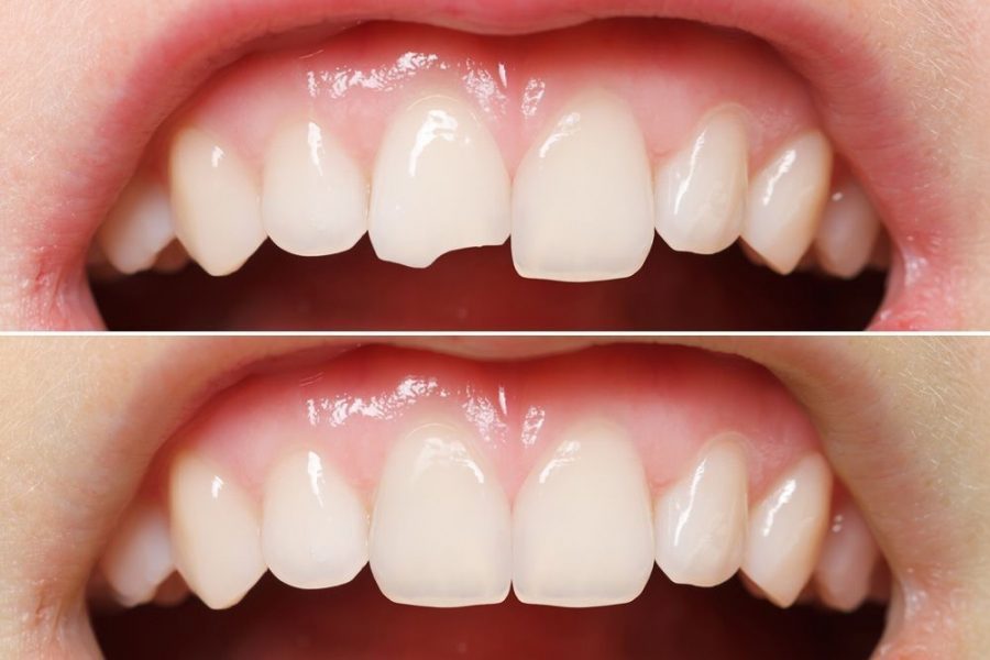 chipped cracked tooth