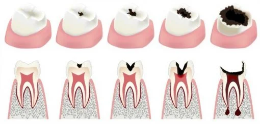 mercury dental filling cavity