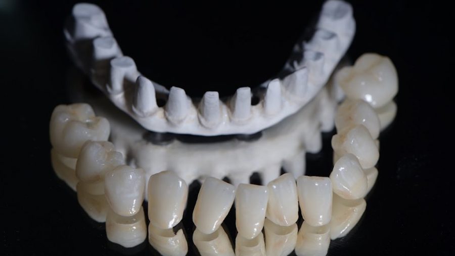 PEEK framework crowns
