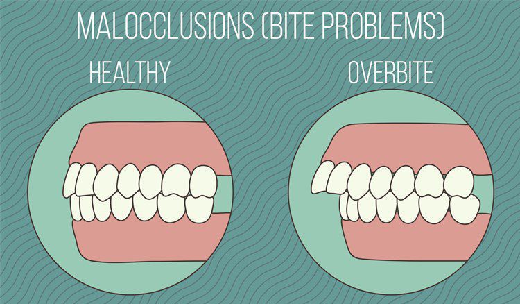occlusion balance