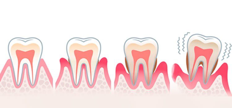 tooth mobility