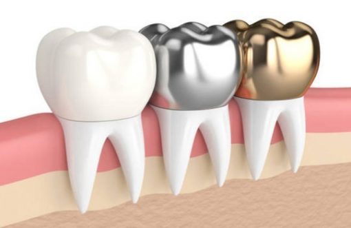ceramic dental crown