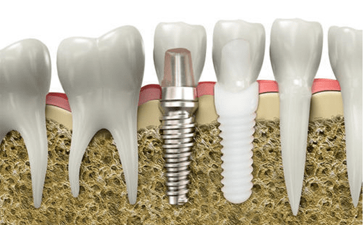 zirconia and titanium implant