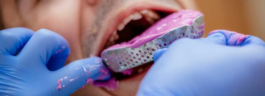 Dental Impressions