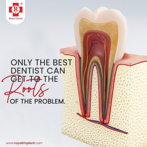 Root Canal Treatment Save Your Teeth