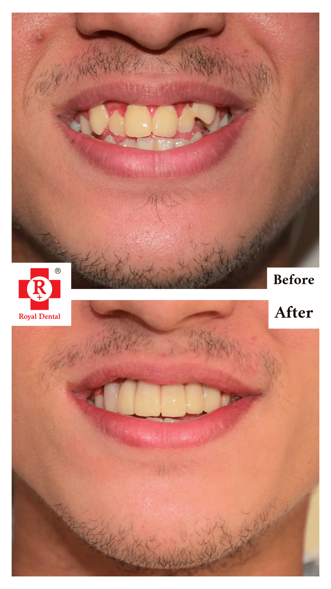Crooked Teeth