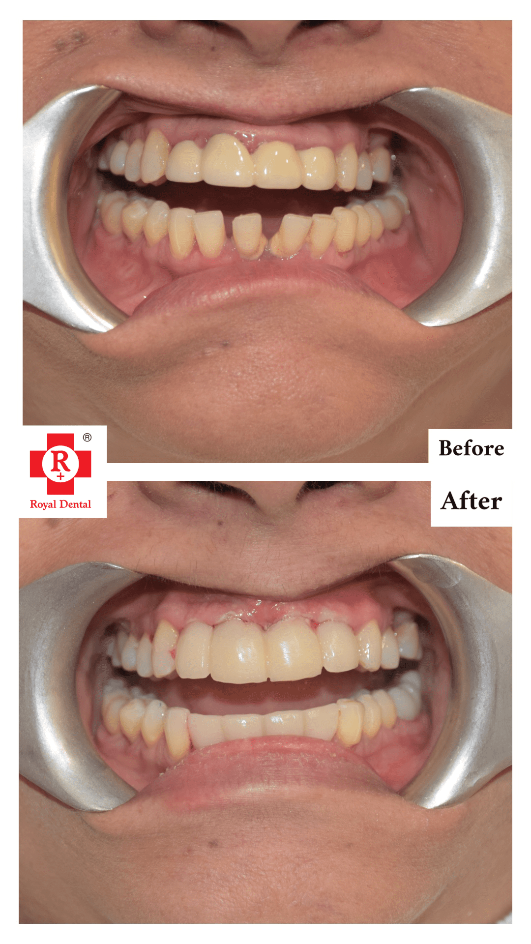 Dental Implants