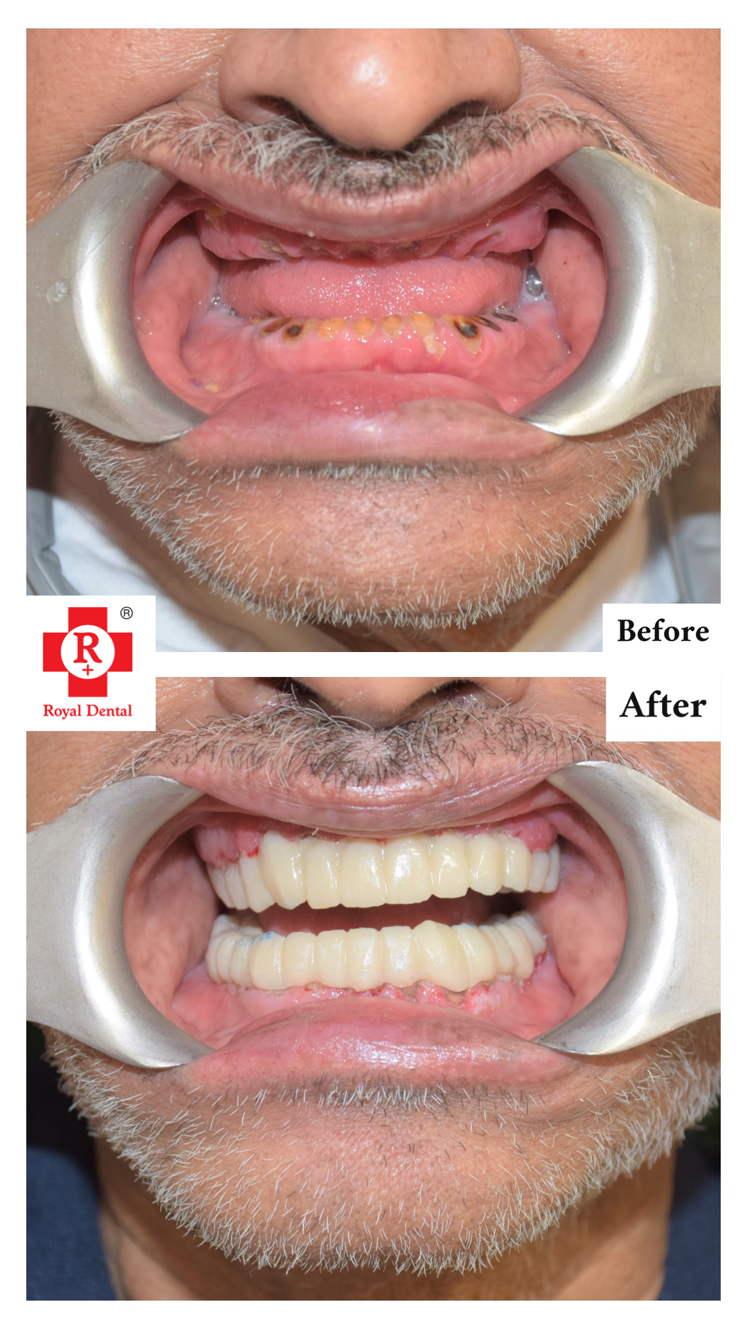 fixed-teeth