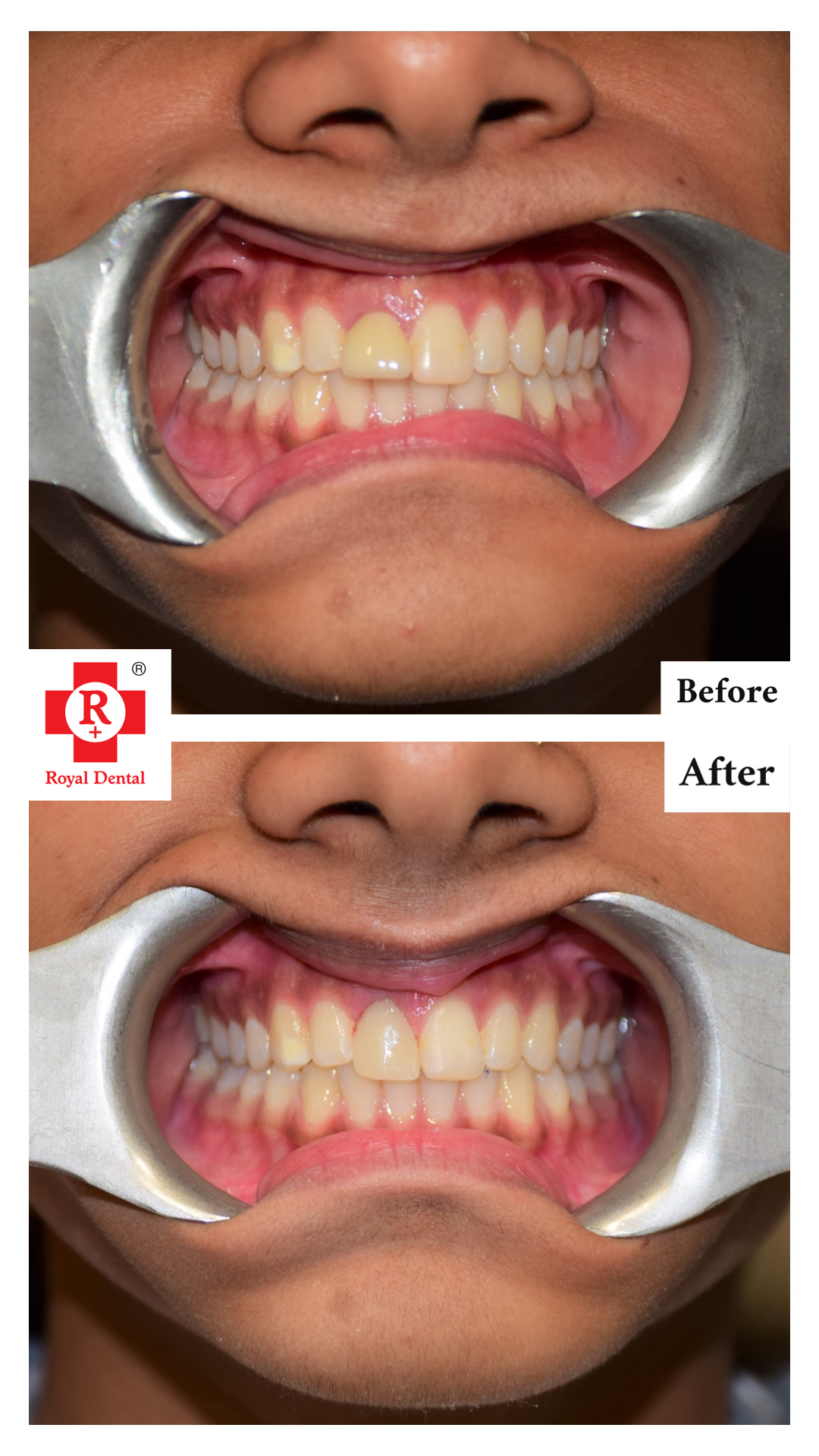 Top 10 Best Dentists in Bangalore! 6 Single tooth replacement