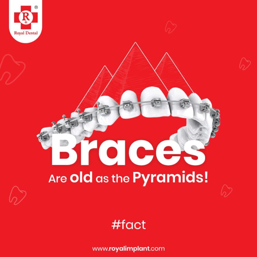dental braces