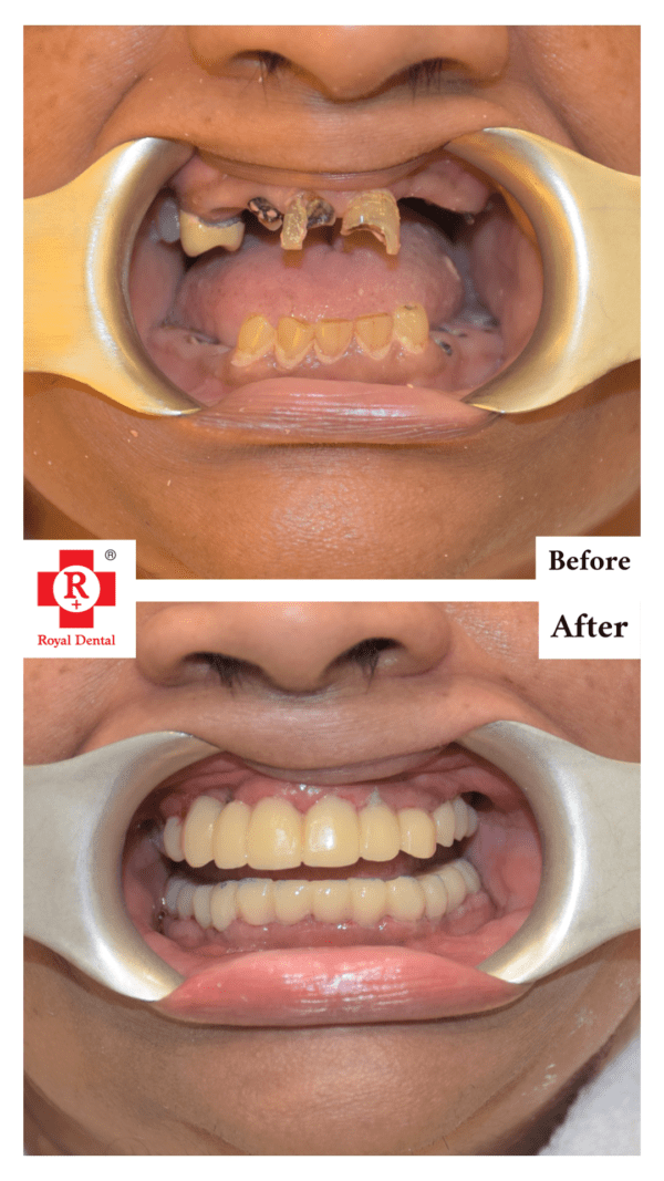 Full Mouth Implants