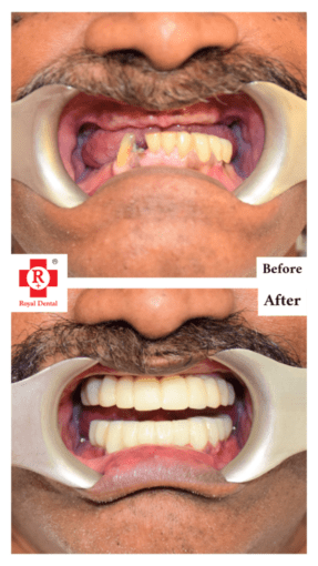Before After Implant