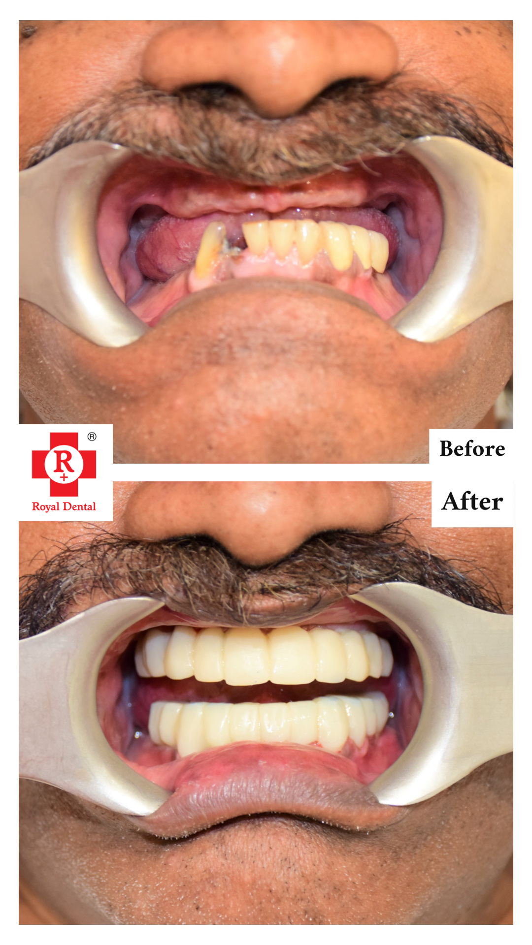 oral-cancer-oral-surgery