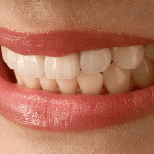 teeth veneers and crowns