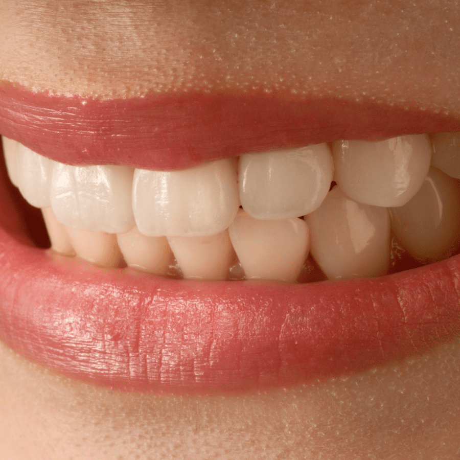 teeth veneers and crowns break