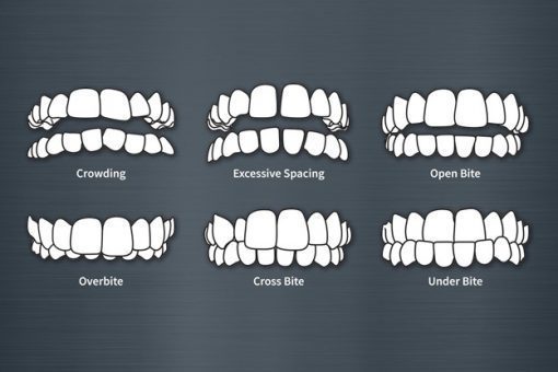 types of bite