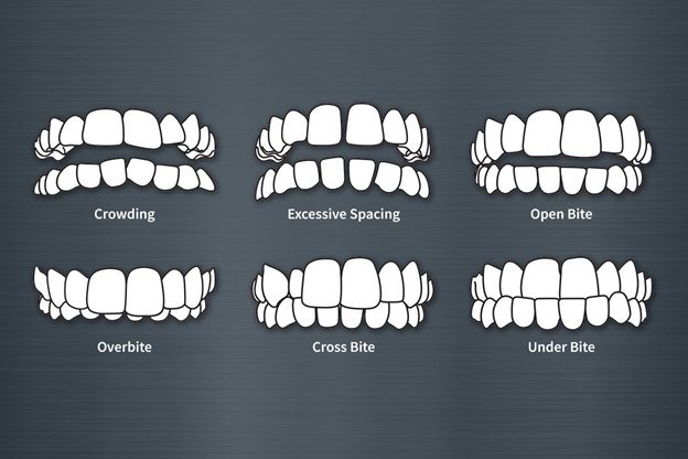 types-of-crooked-teeth-in-adults