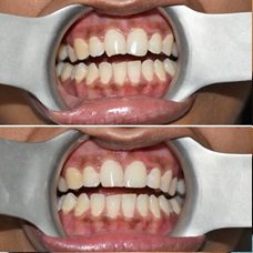 cosmetic conturing