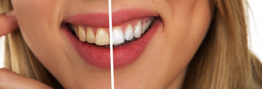 Women before and after teeth cleaning safe procedure