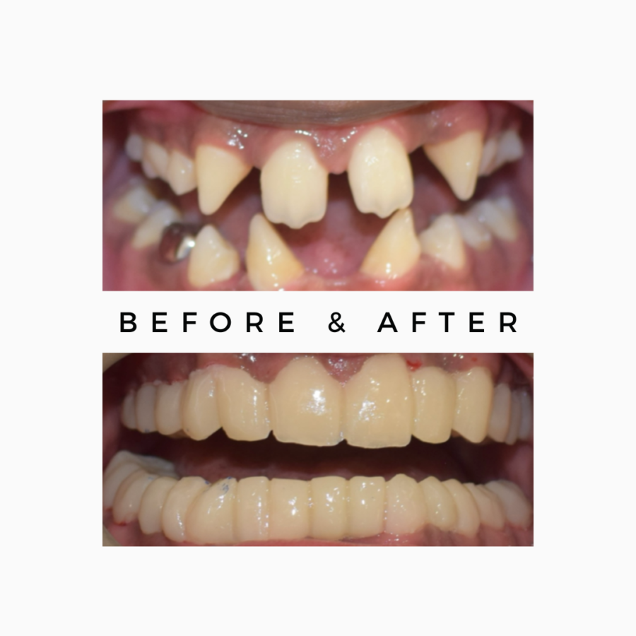 Crooked Teeth Correction