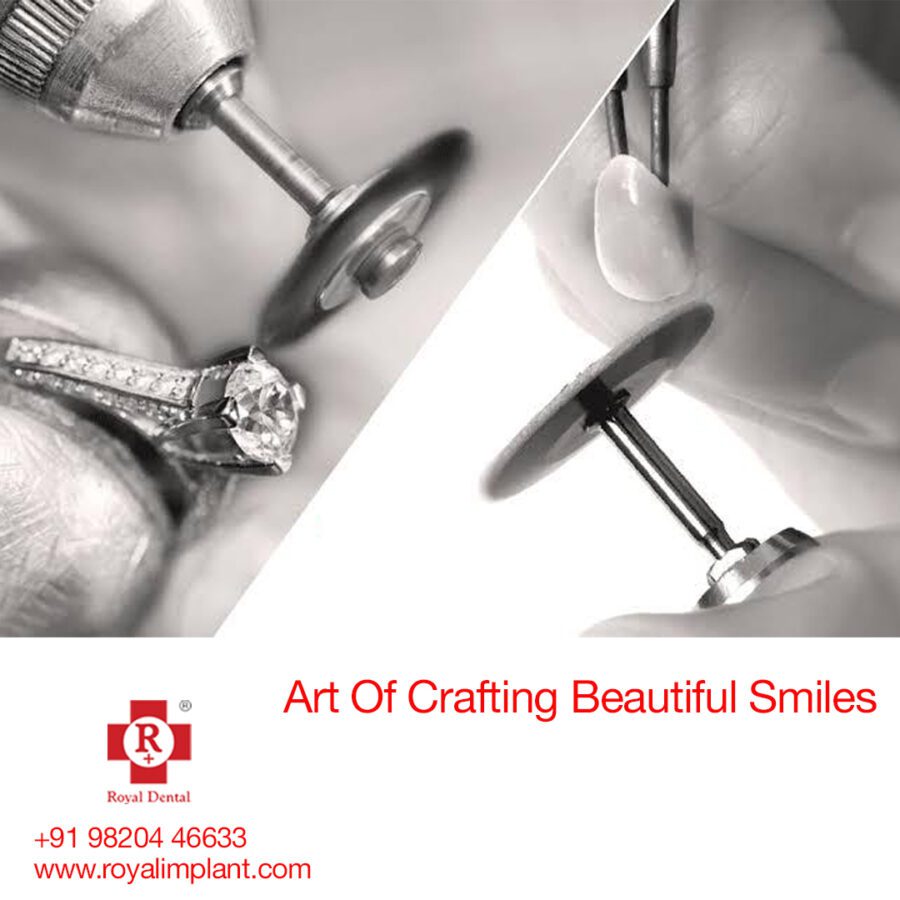 High Impact Polymer Composite SAPTeeth
