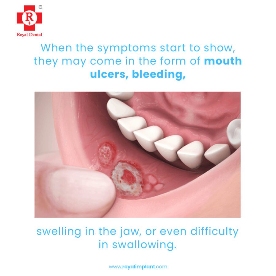 oral ulcer