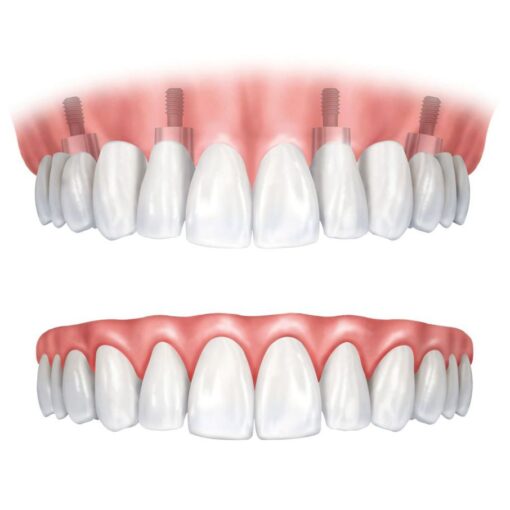 All-on-four denture vs dental implant