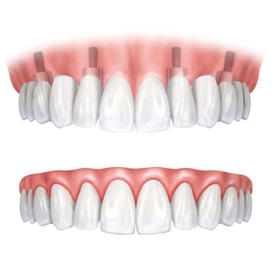 denture vs dental implant