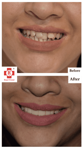 Teeth Straightening