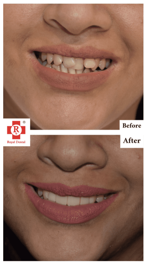 crooked teeth