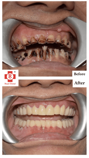 Stained Teeth