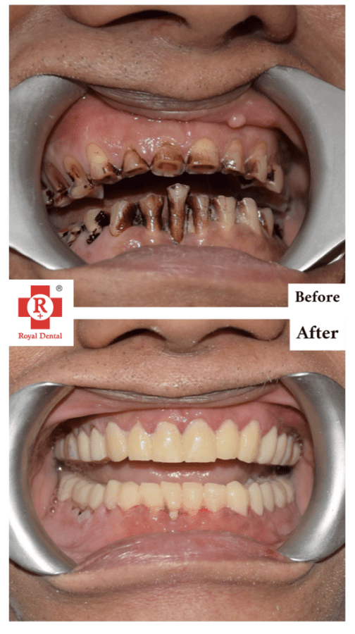 Dental Crown or Natural Teeth Turning Black