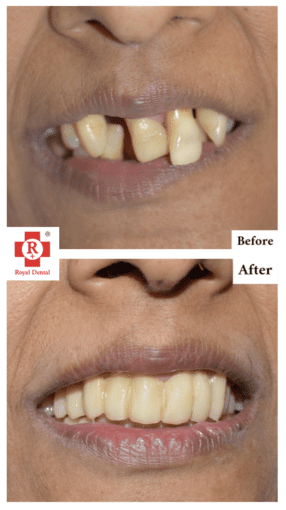 Teeth Mobility