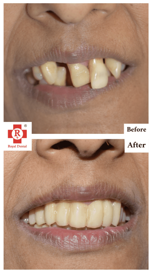 Teeth Mobility