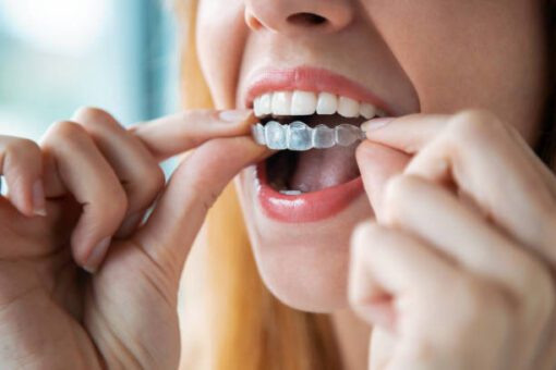 women wearing dental night guard in mouth