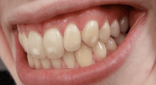 white spot on teeth