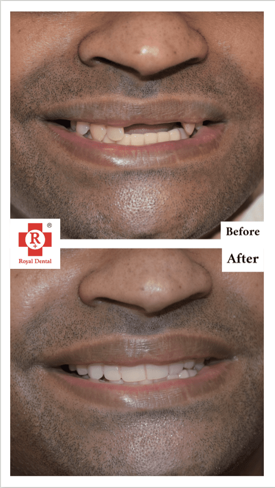 Missing Teeth