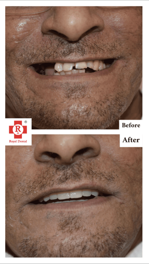 Fixed Teeth