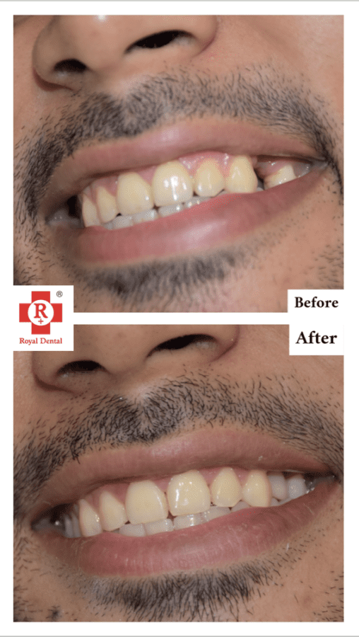 Single Tooth Implant