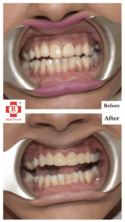crooked teeth