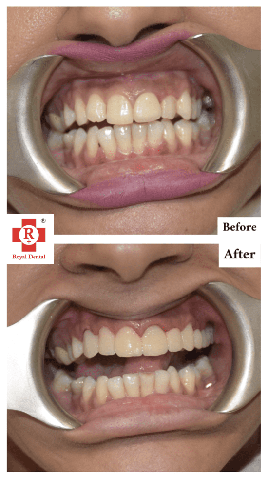 Crooked Teeth