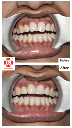 Cosmetic Tooth Contouring