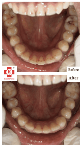 Oral Prophylaxis