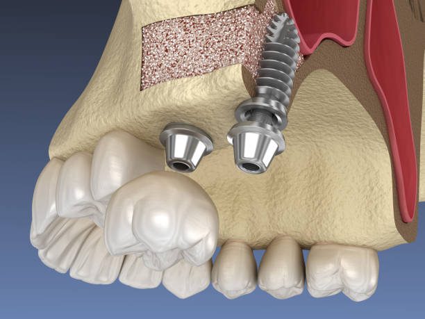 sinus lift with bone graft