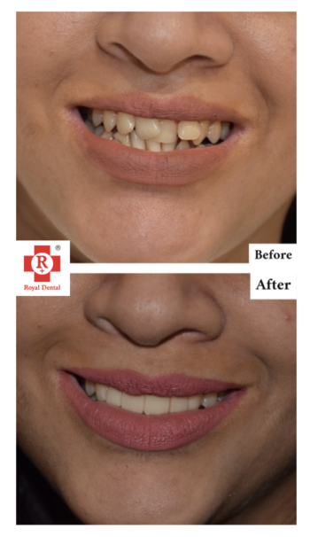 Smile Makeover for Teeth Crowding