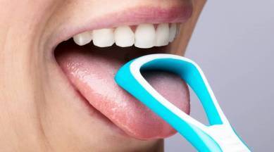 White Tongue