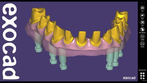 digital smile design exocad