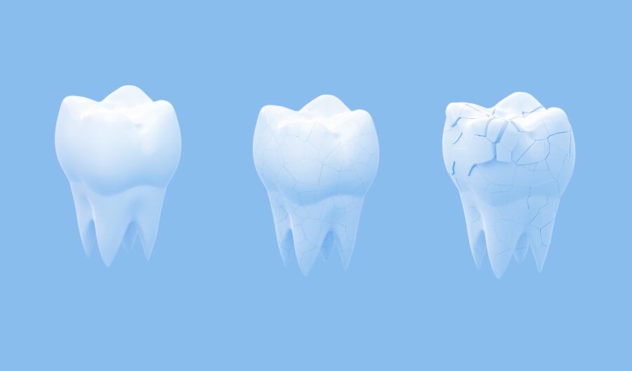 Tooth Erosion Brittle - Artificial Teeth