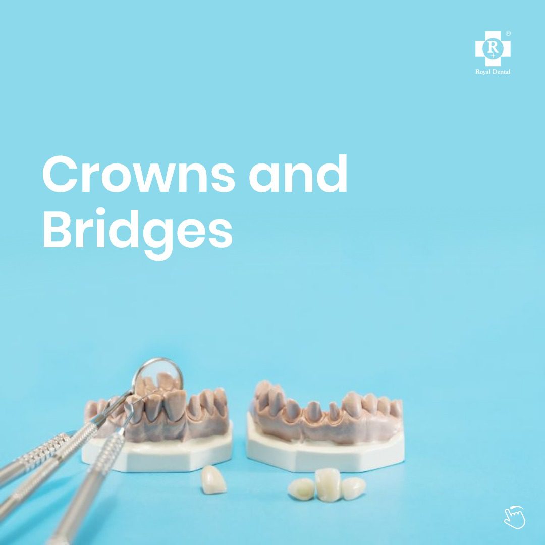 crowns and bridges